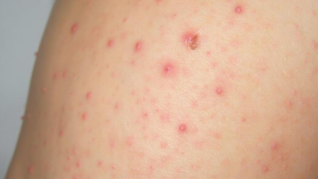 boil versus pimple differentiation